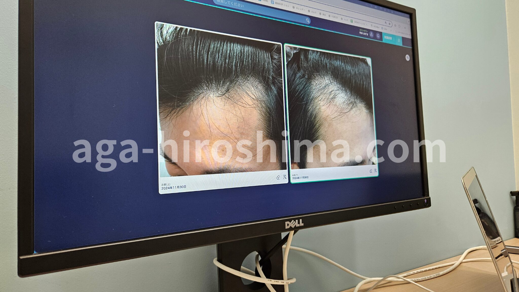 AGAヘアクリニック梅田院のカウンセリング